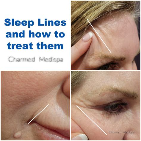 The Distinction Between Sleep Lines and Aging Lines – Charmed Medispa