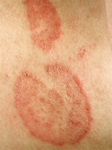 Tinea Corporis Symptoms Causes Diagnosis And Treatment | My XXX Hot Girl