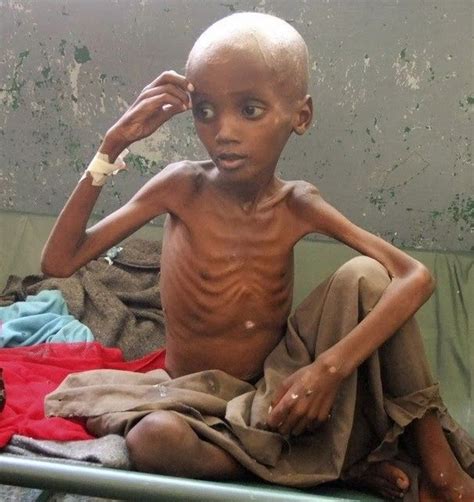 starving kid in africa picture - hackervietnamka