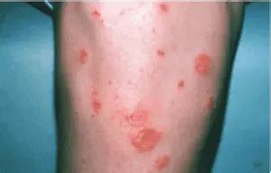 Impetigo Treatment | Types of Impetigo | Skin Doctors in Florida