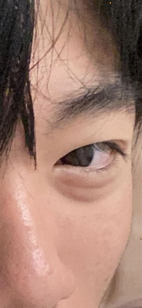 how to remove eyebags 7