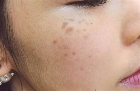 nevus hori dr le hoai huong