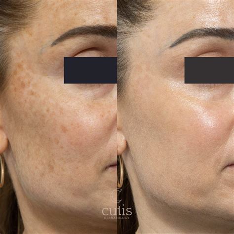 picosure laser treatment brisbane picosure pro laser cutis clinic