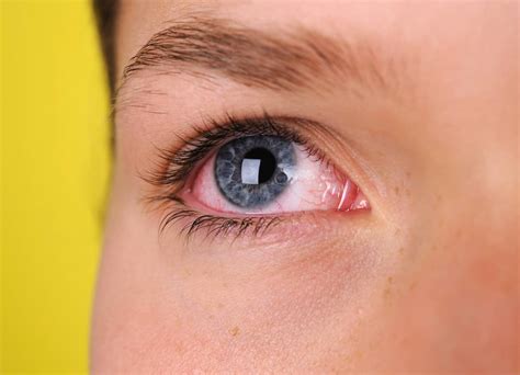Bloodshot Eyes: Causes, Diagnosis, and Treatment- K Health