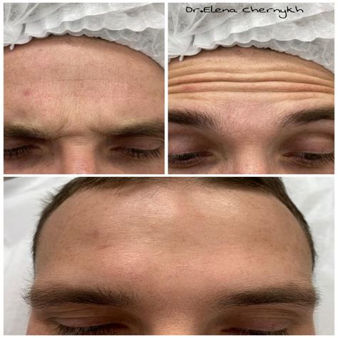 Ботулинотерапия