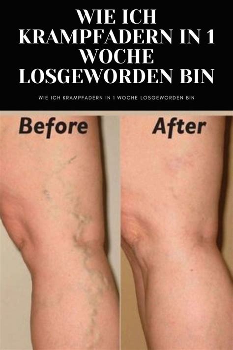 How to get rid of spider veins naturally in 2 weeks – Artofit