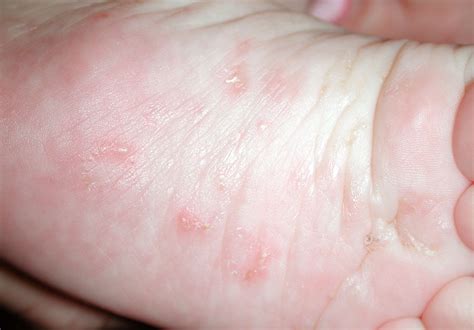 scabies diagnosis  management bpacnz