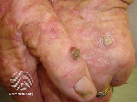 Squamous Cell Carcinoma: Symptoms and Treatment | Pinnacle Dermatology