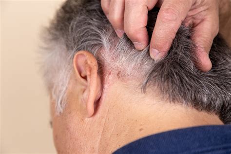 cara menghilangkan kerak psoriasis di kepala 3