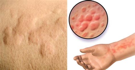 Cold Urticaria: Symptoms, Causes, and How to Treat Being Allergic to ...