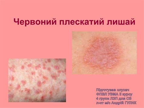Червоний плескатий лишай лекція дерматологія | PPT