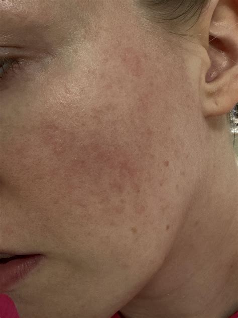 random face rash    rdermatologyquestions
