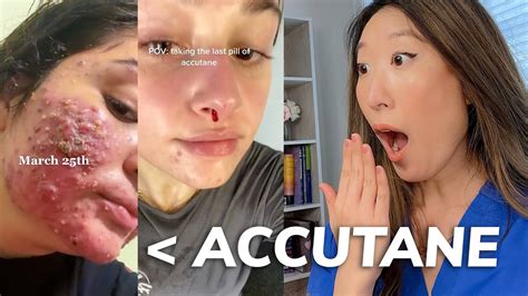 EVERYTHING you need to know about ACCUTANE: Dermatologist Explains ...