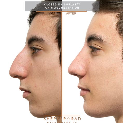 Chin and Jaw Implants in Washington DC | Sherber + Rad
