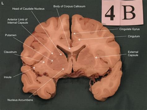 Brain Anatomy Corpus Callosum Caudate Nucleus - vrogue.co