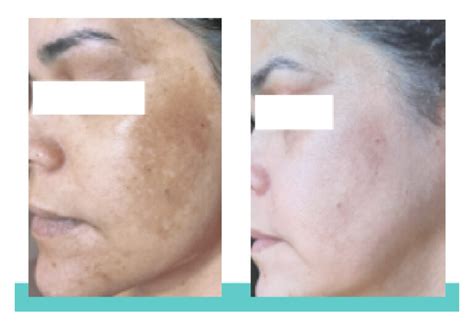 Flebon Melasma Antes E Depois - Melasma: confira o antes e depois do tratamento - Blog Ada Tina