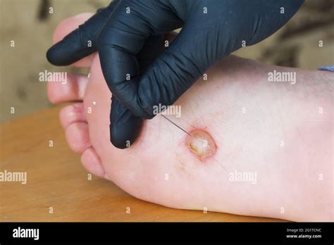 Dyshidrotic eczema on the foot. Blister dermatitis. A gloved hand holds ...