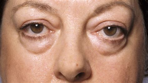 clinical challenges knowing   thyroid eye disease medpage today
