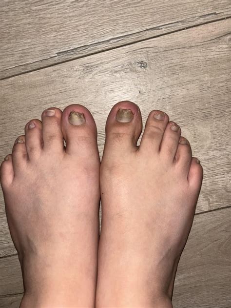 Terbinafine Course : r/NailFungus