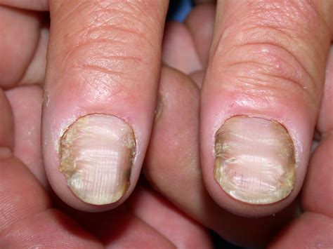 management  fungal nail infections bpacnz