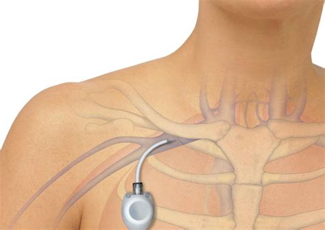 Catéter Port-a-cath Quimioterapia Preço - Quimioterapia: por que o Cateter Totalmente Implantado (Port-a-Cath) é ...