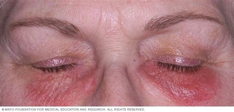 contact dermatitis disease reference guide drugscom