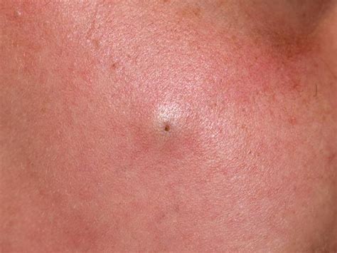 Epidermoid Cyst Sebaceous Cyst South East Skin Clinic