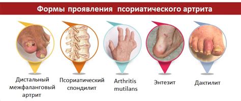 Псориатический артрит – симптомы, диагностика, лечение и фото