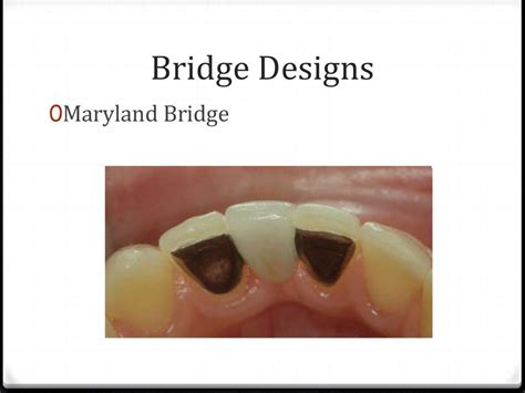 Resin Bonded Bridges