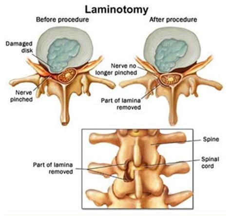 Laminotomy Vs Laminectomy - Which One to Choose?