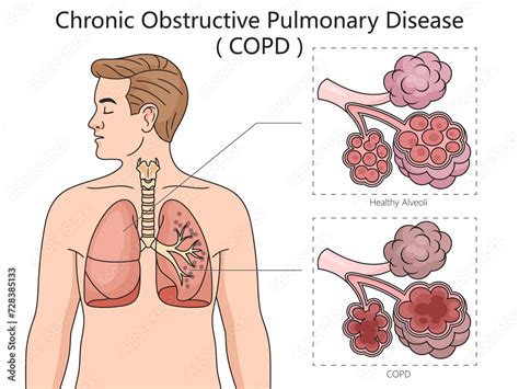 ilustracion de stock chronic obstructive pulmonary disease copd diagram