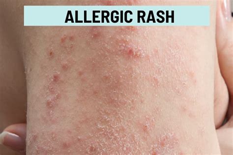 Itchy Bumps on Skin: 21 Causes, Pictures, and Treatment