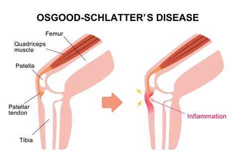 What is Osgood-Schlatter’s Disease? | Panther Sports Medicine