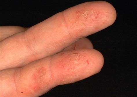 irritant contact dermatitis hand