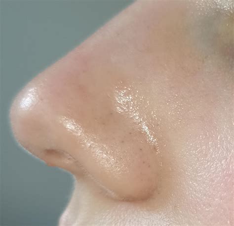 Blackheads getting worse 1.5 years post accutane. Retinol/adapalene