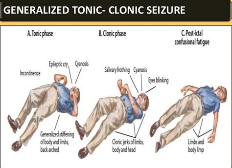 grand mal seizure  symptoms  effects recovery time