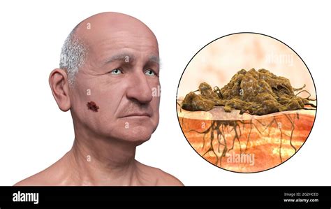 Malignant melanoma face hi-res stock photography and images - Alamy