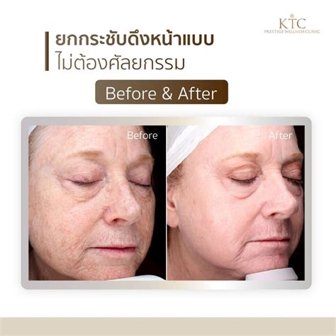 ultraclear ktc clinic