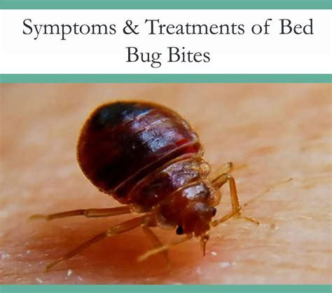 Bed Bug Bites - Symptoms and Treatments - The Pest Advice