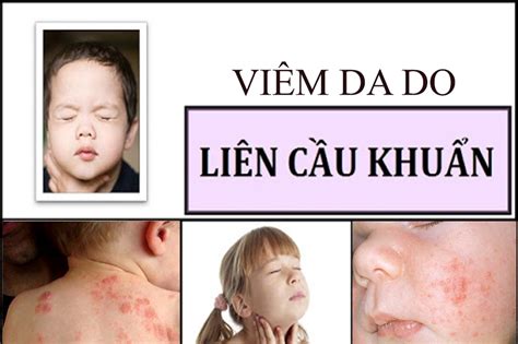 viem da lien cau  nguy hiem khong trieu chung cach phong va dieu tri