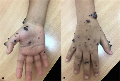 Localized eruptive acquired multiple angiokeratomas with spontaneous