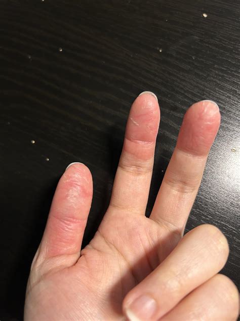 Dyshidrotic Eczema Fingers