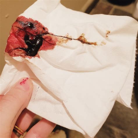 picture of a miscarriage blood clot 11