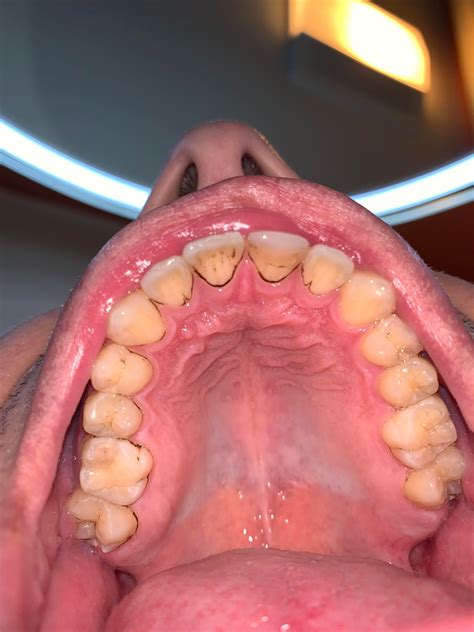 20M. Why do my teeth look so bad? I brush my teeth twice a day every