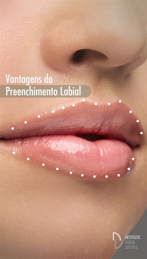 Gravida Pode Fazer Preenchimento Labial - Preenchimento Labial Antes e Depois: Veja os Resultados - Instituto ...