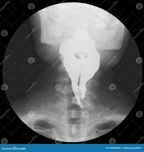 Barium Swallowing Study Of A 21 Years Old Woman, Demonstrated Normal