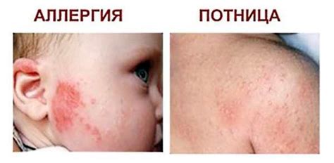 Как выглядит потничка у грудничков фото на теле