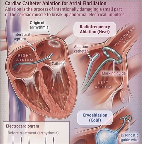 Atrial fibrillation – Artofit