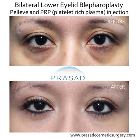 Benefits of PRP Injection Under Eyes - Dr. Prasad | New York
