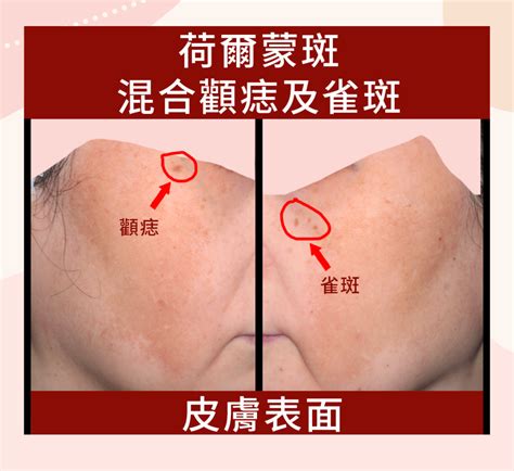 打3次excel V激光去荷爾蒙斑已幾乎打清大部份荷爾蒙斑